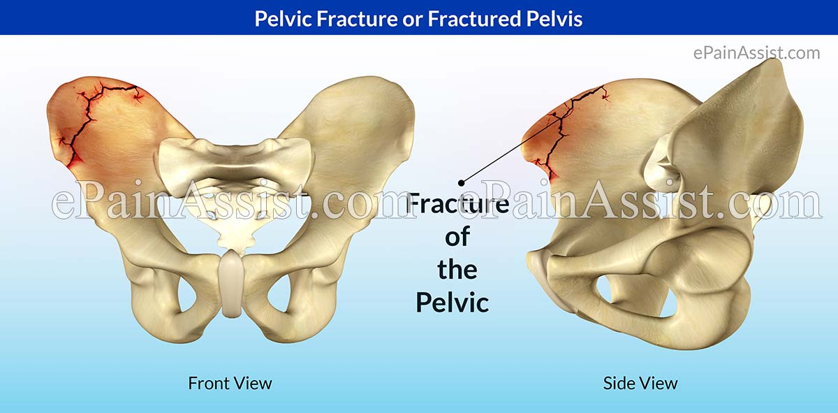 Cracked pelvis treatment and recuperation pictures